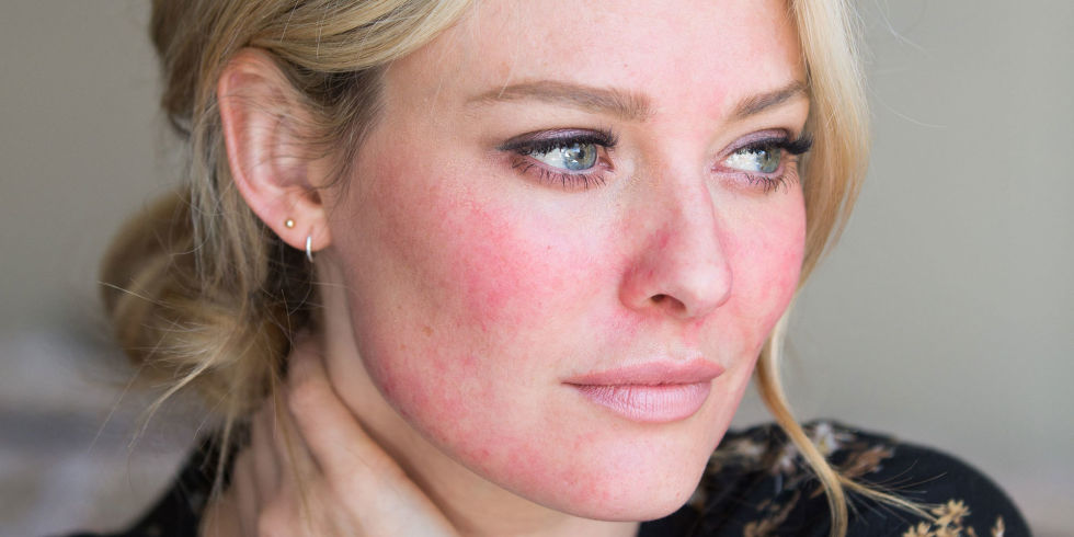 Rosacea on face