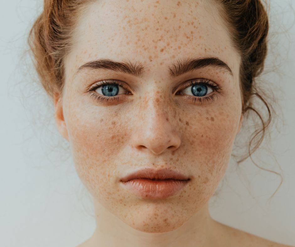 Hyperpigmentation treatment
