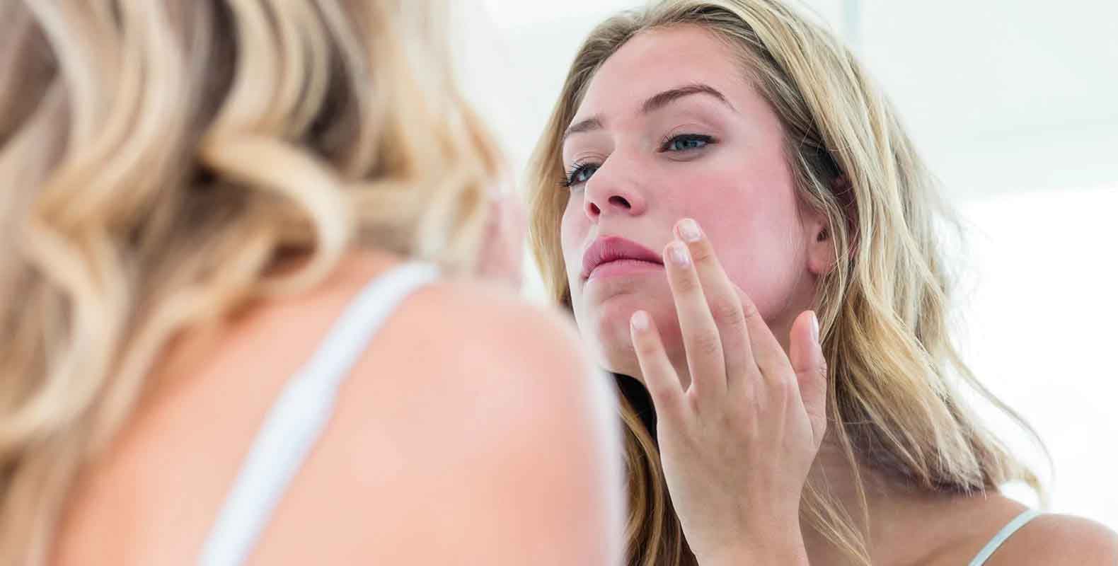 Rosacea flare-up